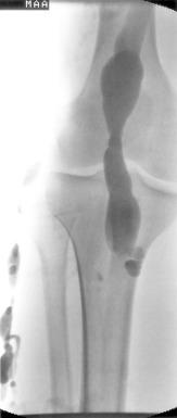 FIG 9.4, Aneurysmal dilation of the popliteal vein with a band-like narrowing associated with an atypical lateral varicosity in a 19-year-old male with Klippel-Trenaunay syndrome.