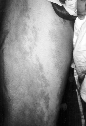 FIG 9.6, Port-wine stain (capillary malformation) on affected extremity of patient with Klippel-Trenaunay syndrome. Note also large lateral embryonic vein of the thigh.