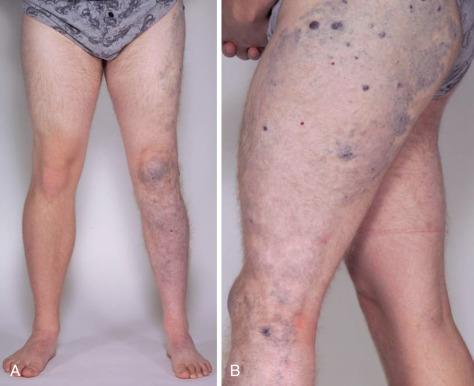 FIG 9.7, In Servelle-Martorell syndrome (A, anterior view, B, lateral view) the typical venous malformation is extratruncular and diffuse. The affected extremity is shorter, there are phleboliths present on plain radiographs, and there is no arteriovenous shunting. Spontaneous bone fracture and osteopenia are frequent. There are usually no port-wine stains.