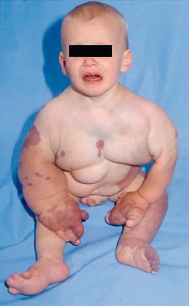 FIG 9.8, Patient with Proteus syndrome consisting of disproportionate overgrowth of multiple tissues, vascular malformations, and connective tissue or linear epidermal nevi. The patient had multiple lipomas and hyperostosis.