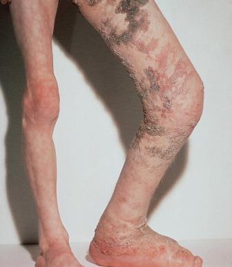 FIG 9.9, Klippel-Trenaunay syndrome with overgrowth of the left lower extremity by 12 cm.