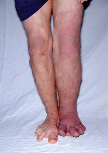 FIG 9.10, Klippel-Trenaunay syndrome with involvement of both lower extremities. Note the port-wine stain and digital anomalies.