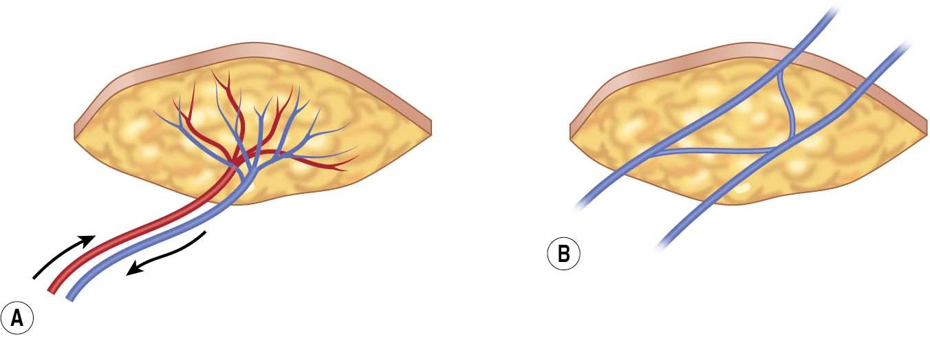 FIGURE 93.1, (A) Traditional flap and (B) venous flap.