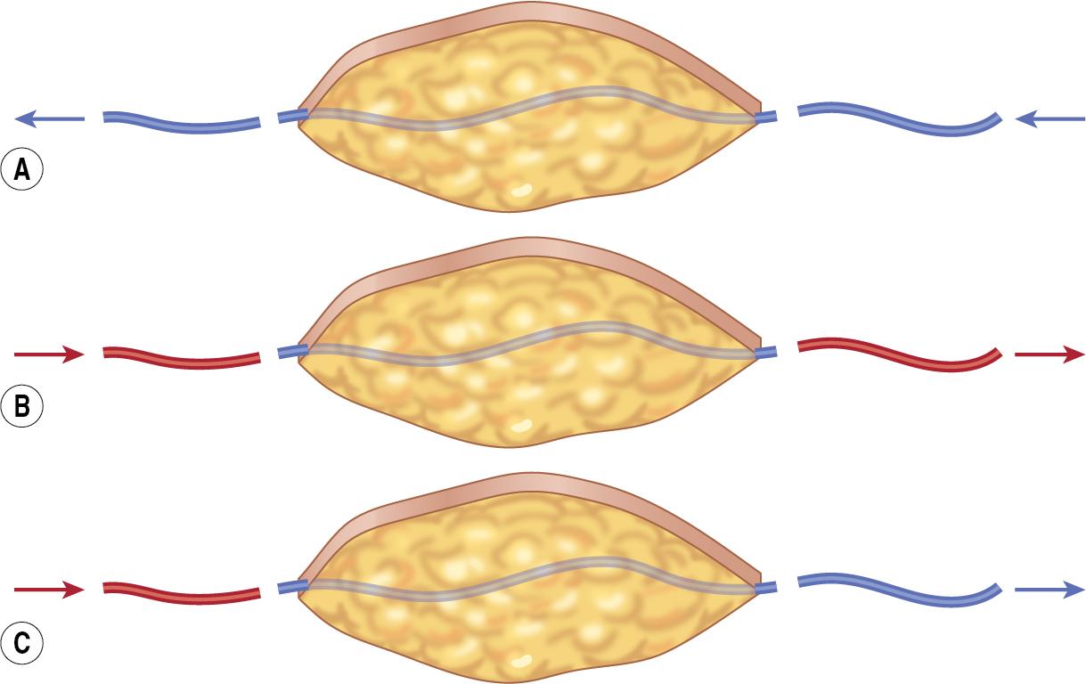 FIGURE 93.2, (A) Purely venos flap; (B) Arterial flow-through flap (A-A type) (C) Arterial inflow and venous outflow flap (A-V type). The arrows represent the direction of blood flow. The red color indicates arterial blood flow; the blue color indicates venous blood flow.