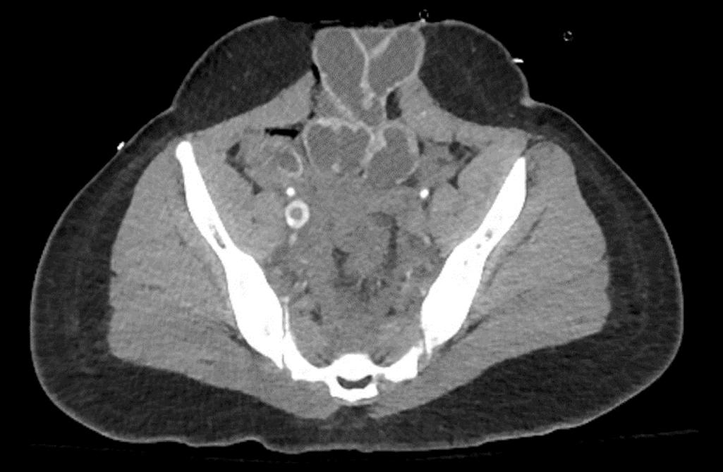 FIGURE 2, Occult free-floating thrombus seen in right internal iliac vein.