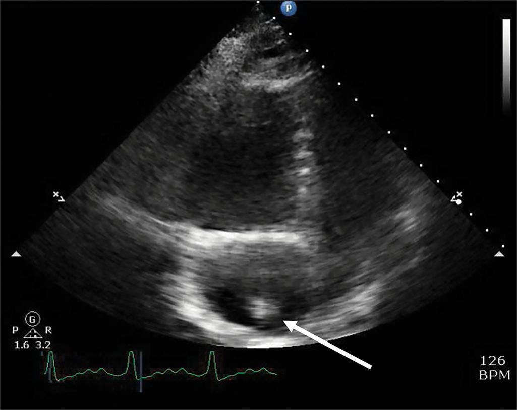 FIGURE 3, Echocardiogram showing clot in transit.