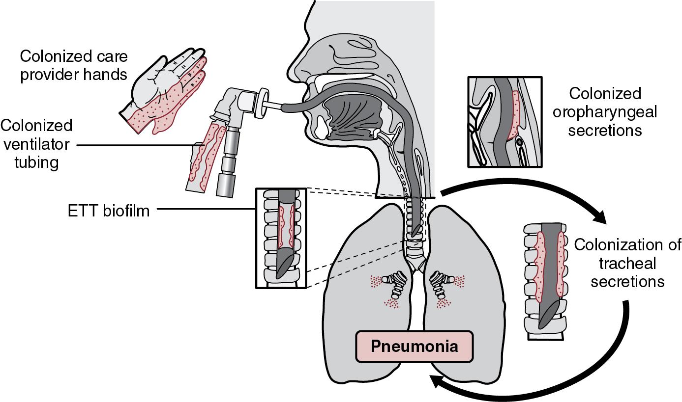 Fig. 5.2, Pathogenesis of ventilator-associated pneumonia. Colonization of the upper airway can originate from care provider hands, ventilator equipment, oropharyngeal secretions, or a biofilm within the endotracheal tube (ETT). Ultimately, pathogenic organisms spread into the trachea, where the population expands and moves downward into the small airways and lung parenchyma, causing pneumonia.