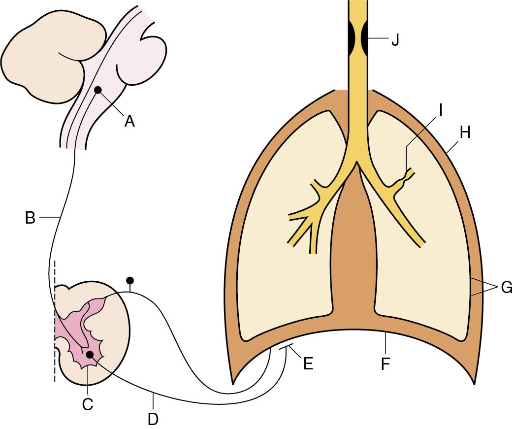 • Fig. 27.2, Summary of sites at which lesions, drug action or malfunction may result in ventilatory failure. A, Respiratory centre; B, upper motor neuron; C, anterior horn cell; D, lower motor neuron; E, neuromuscular junction; F, respiratory muscles; G, altered elasticity of lungs or chest wall; H, loss of structural integrity of chest wall and pleural cavity; I, increased resistance of small airways; J, upper airway obstruction.