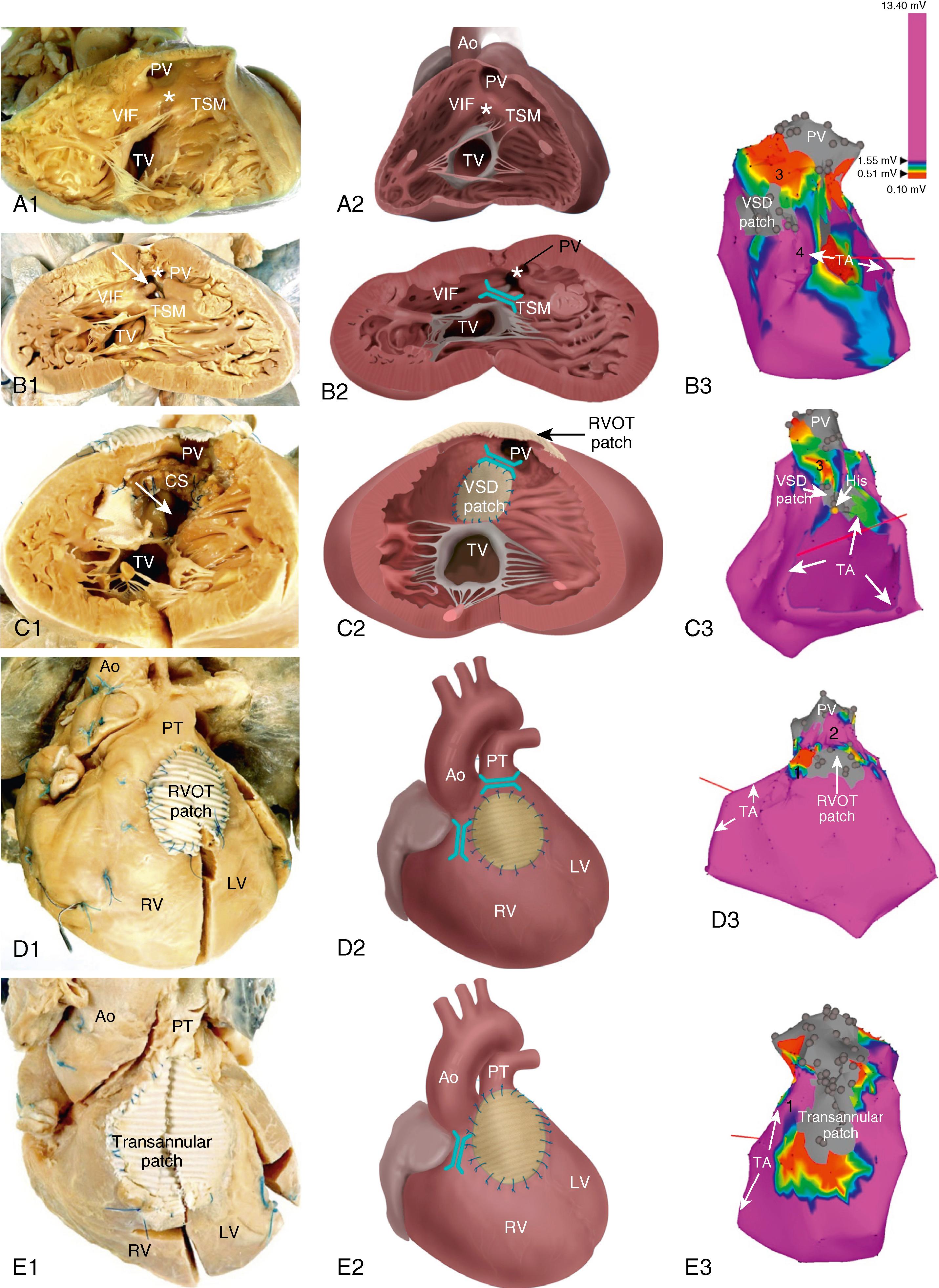 Fig. 116.1, Tetralogy of Fallot (TOF) isthmus.