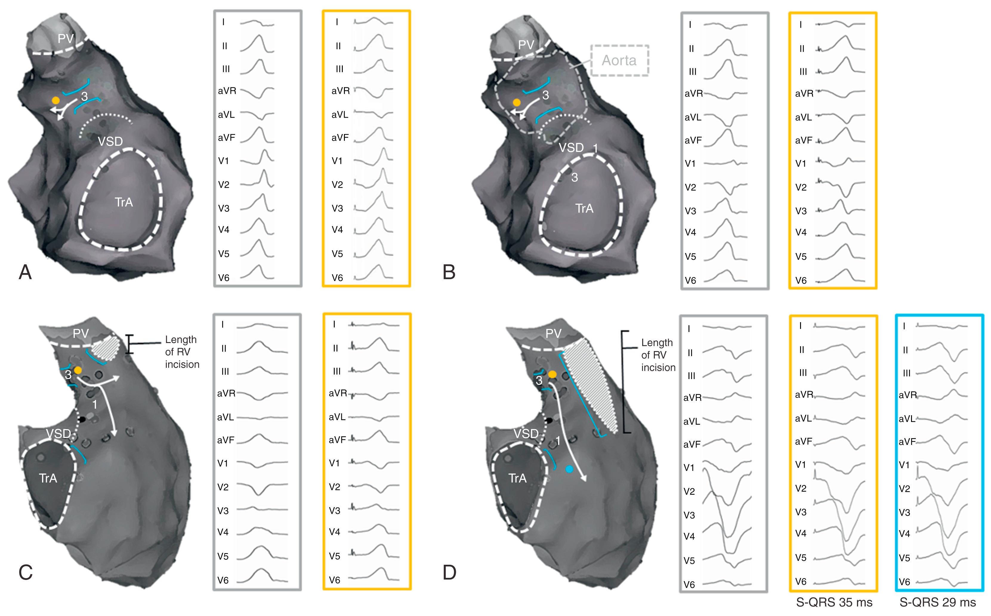 Fig. 116.4, 12-lead ventricular tachycardia (VT) electrocardiogram (ECG) in repaired tetralogy of Fallot.