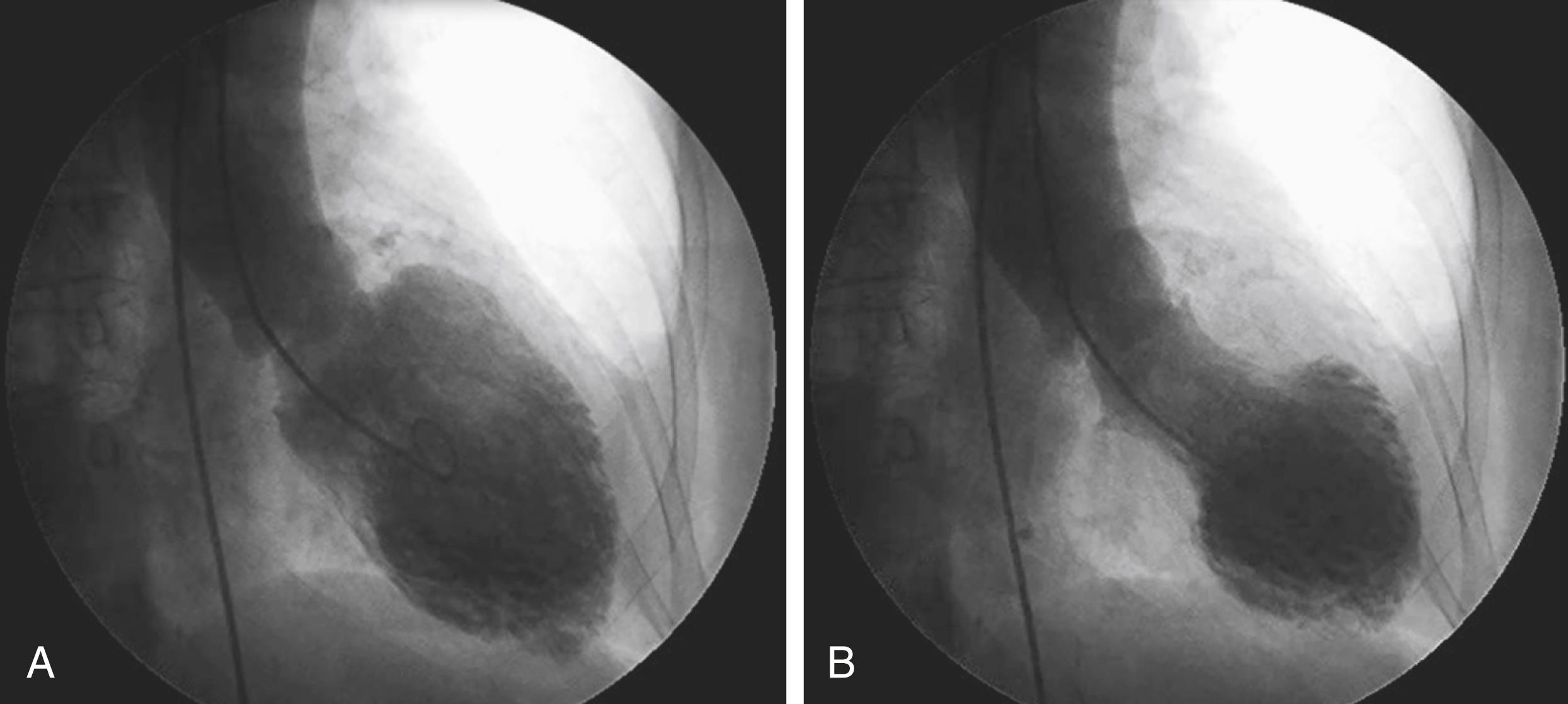 Fig. 93.1, Left ventriculogram in a patient with takotsubo cardiomyopathy in the right anterior oblique projection.