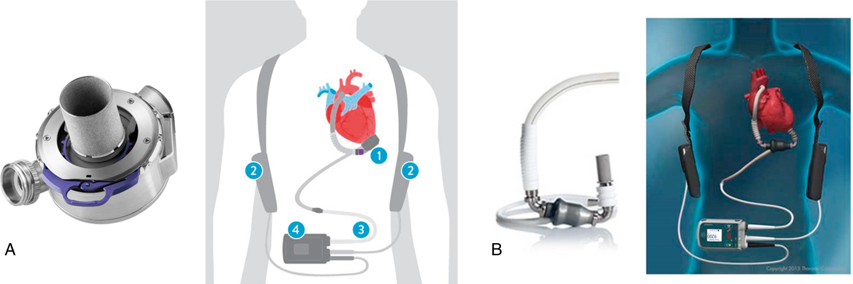 Fig. 111.1, US Food and Drug Administration–approved ventricular assist devices (VADs).