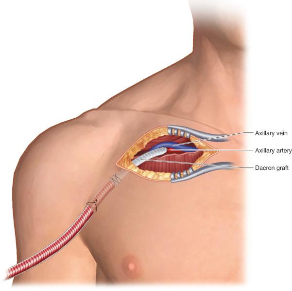 Figure 32.8, Right axillary artery exposure with tube graft anastomosis for ventricular assist device implantation.