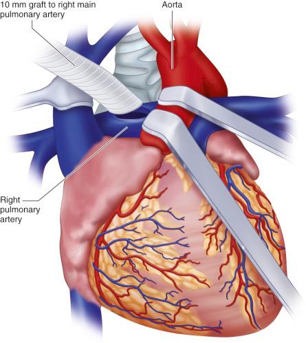 Figure 32.9, Tube graft anastomosis to right main pulmonary artery for right ventricular assist device support.