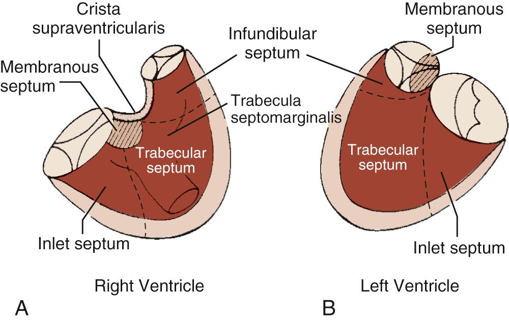 FIGURE 117-1, The components of the ventricular septum as seen from the right ventricle (A) and the left ventricle (B).