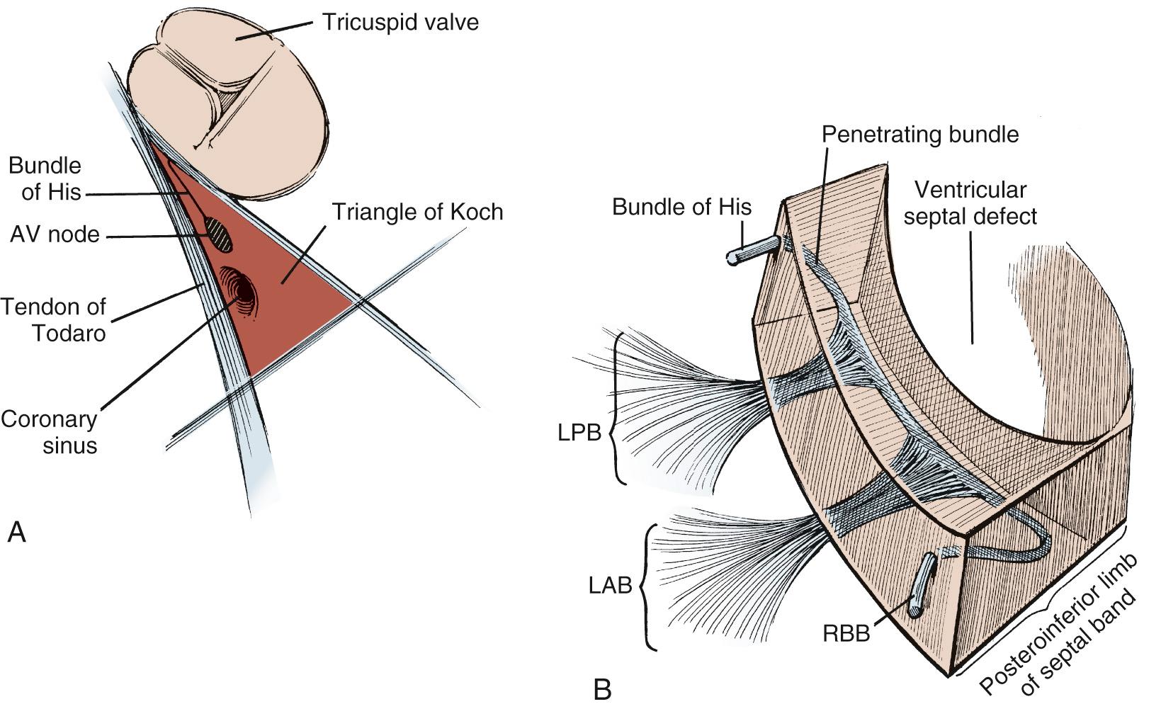 FIGURE 117-2, Schematic representation of the conduction system. A, The atrioventricular (AV) node lies embedded within the triangle of Koch, close to the orifice of the coronary sinus and between the annulus of the tricuspid valve and the tendon of Todaro. The bundle of His originates from the AV node, extends toward the commissure between the septal and anterior leaflets of the tricuspid valve, and penetrates along the posteroinferior margin of the membranous septum and across the muscular ventricular septum. B, The bundle of His gives rise to the left posterior branch (LPB) and the left anterior branch (LAB). The right bundle branch (RBB) then travels back along the ventricular septum toward the right ventricular septal surface. At the level of the muscle of Lancisi, the right bundle branch descends toward the right ventricular apex.