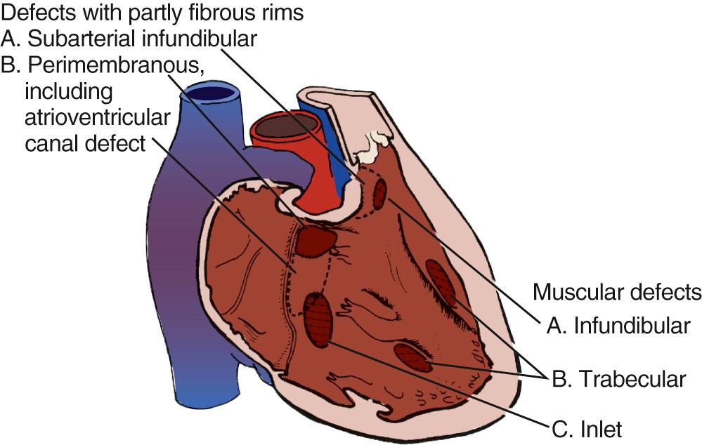 FIGURE 117-3, Classification of ventricular septal defects according to their location in the septum.