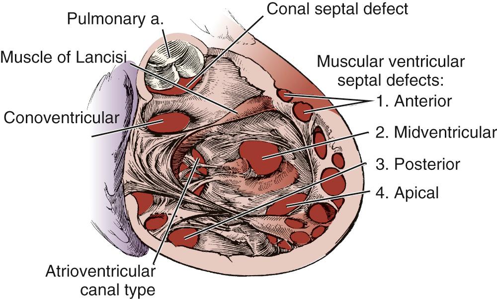 FIGURE 117-4, Classification of ventricular septal defects (VSDs): atrioventricular canal type; muscular VSDs (anterior [1], midventricular [2], posterior [3], and apical [4]); conoventricular septal defect, which includes paramembranous and malalignment conoventricular septal defects; and conal septal defects.