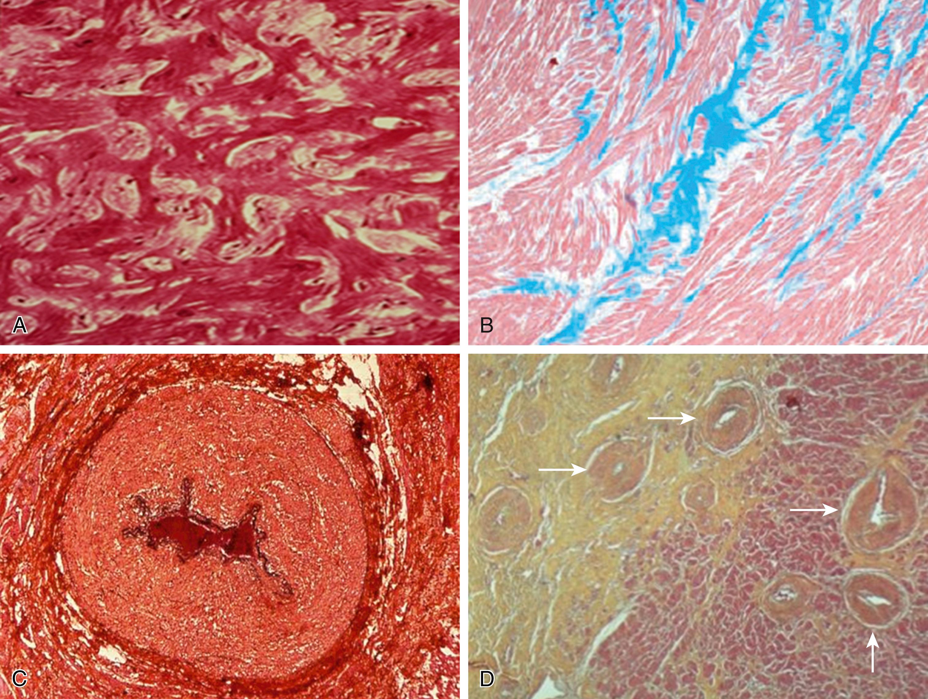 Fig. 89.5, Arrhythmogenic myocardial substrate in hypertrophic cardiomyopathy.