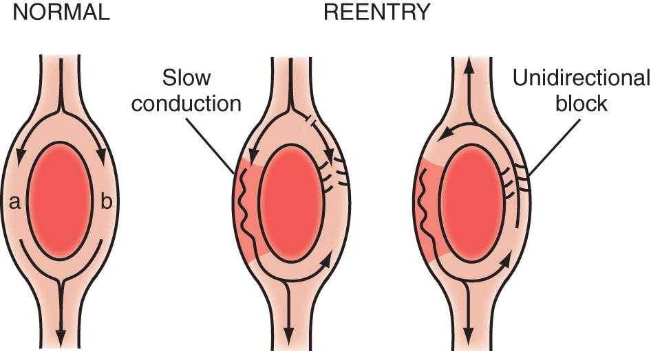 Fig. 72.4, Ring model of reentry.