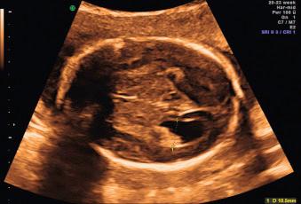 Fig. 43.1, Mild isolated fetal VM at 22 weeks' gestation.