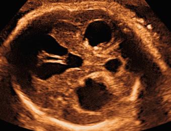 Fig. 43.2, Severe tetraventricular VM with dilatation of posterior, anterior, third, and fourth ventricles in a 30-week fetus.