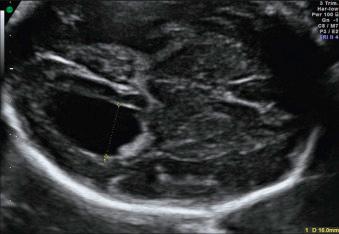 Fig. 43.3, Isolated severe VM in a 22-week gestation fetus with confirmed fetal cytomegalovirus infection.