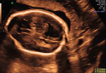 Fig. 43.4, Mild VM in a 22-week fetus with lumbosacral spina bifida.