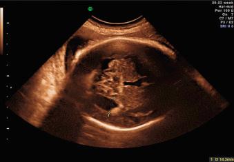 Fig. 43.5, Mild fetal VM in a 23-week fetus with complete agenesis of corpus callosum.