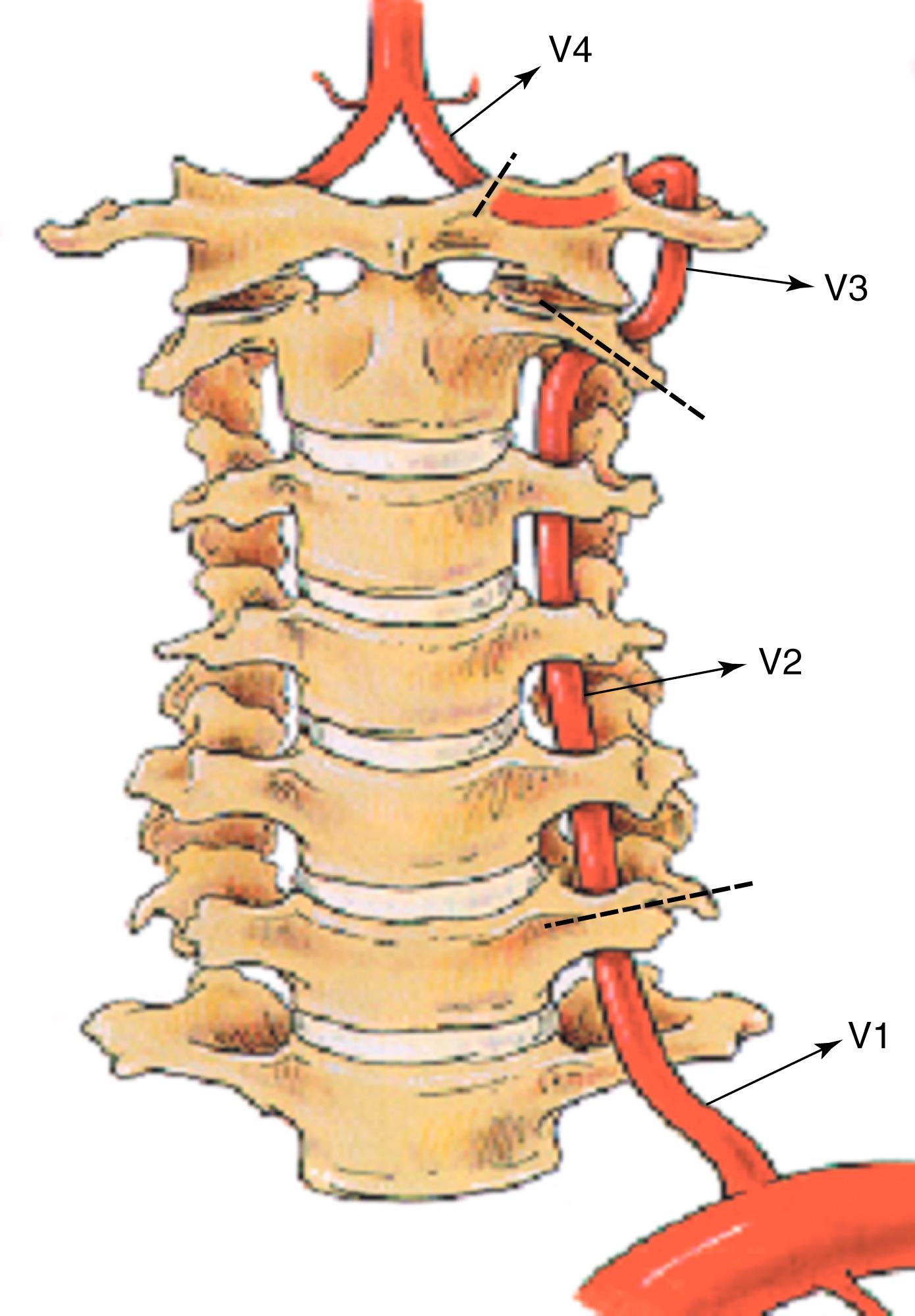 Figure 100.1, The four segments of the vertebral (V) artery.