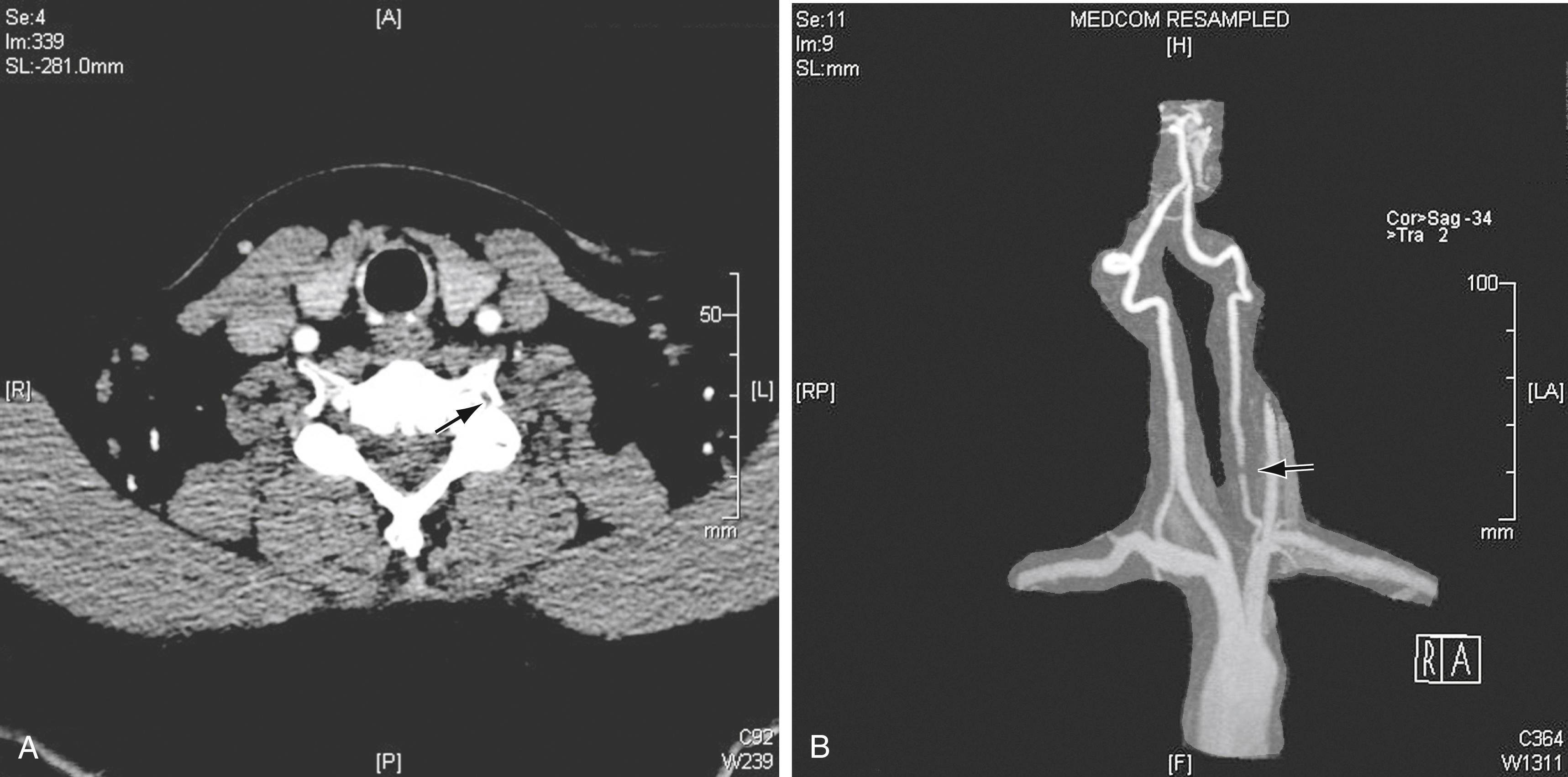 Figure 100.2, ( A ) Computed tomography (CT) and ( B ) magnetic resonance angiography (MRA) images demonstrating large osteophytes occluding the vertebral artery at C5.