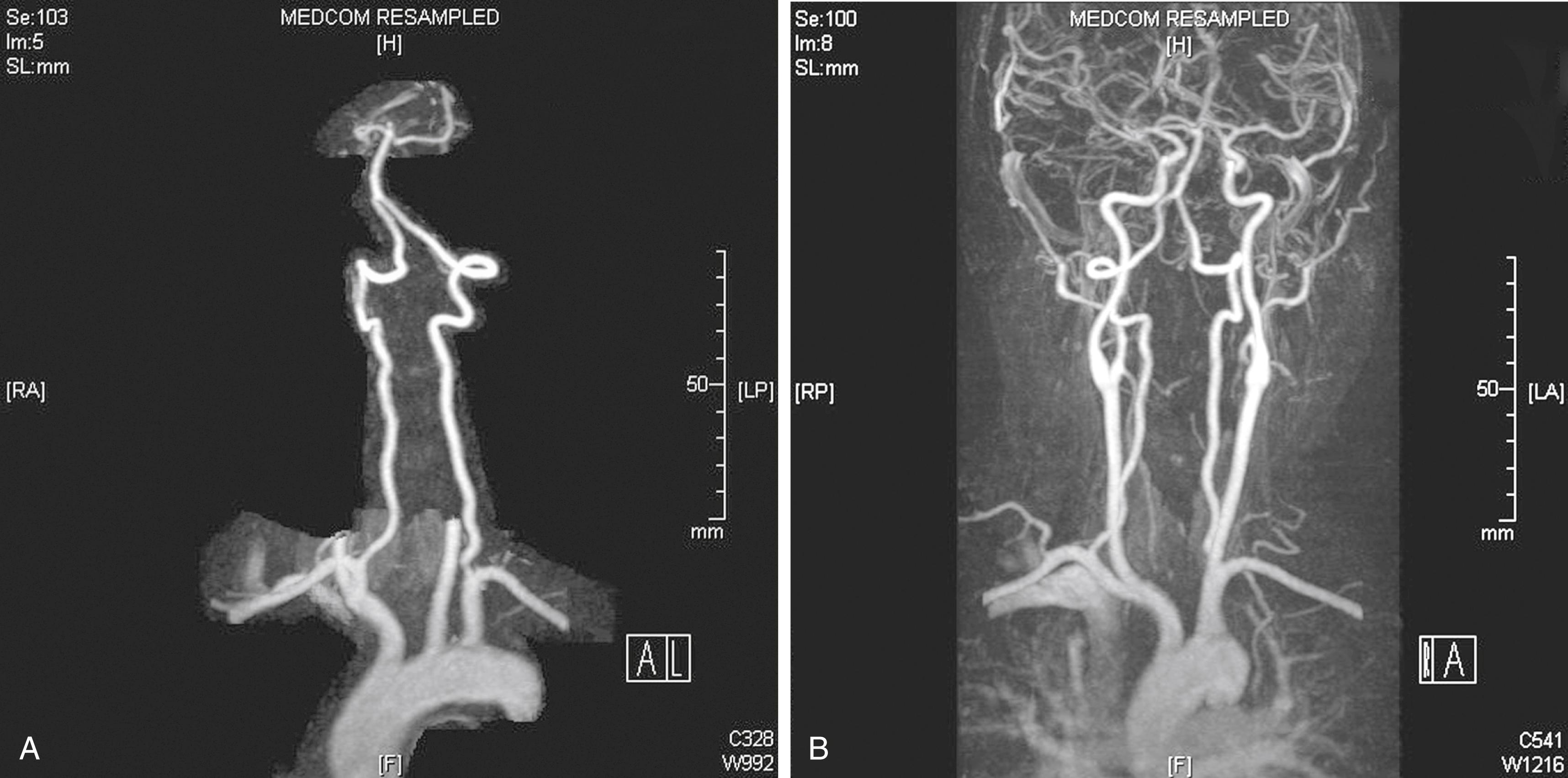 Figure 100.3, ( A ) Vertebral magnetic resonance angiography (MRA) (with the carotid image subtracted). ( B ) Arch and four-vessel MRA.