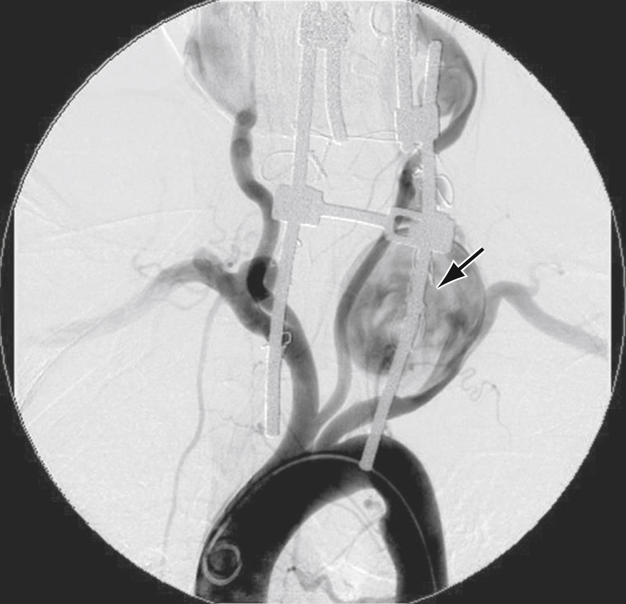 Figure 100.4, V2 segment true aneurysm (arrow) in a patient with connective tissue disorder. Also note the left common right subclavian and right external carotid aneurysms.