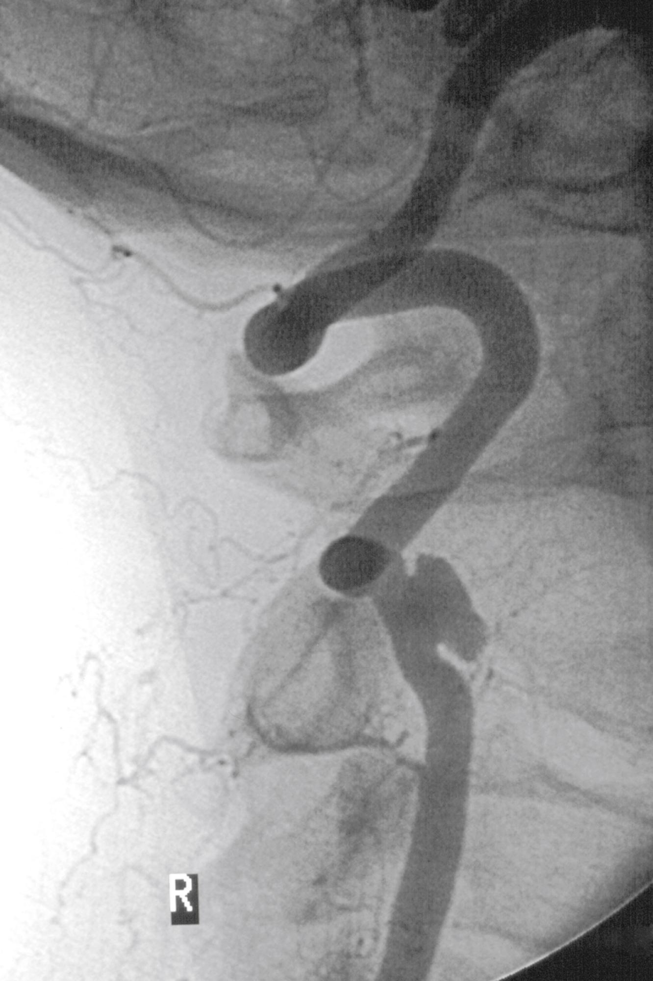 Figure 100.6, Distal V2 segment pseudoaneurysm resulting from dissection.