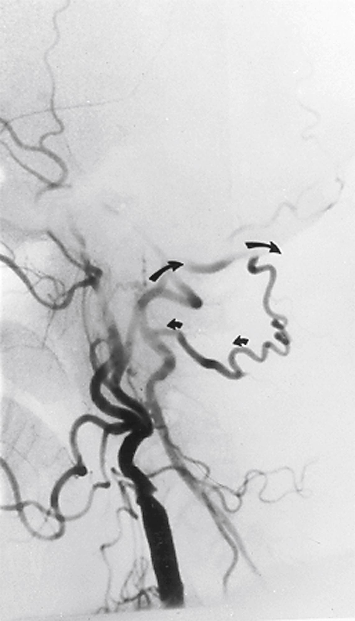 Figure 100.7, The distal vertebral and basilar arteries being fed by an occipital artery collateral in a patient with proximal vertebral artery occlusion.