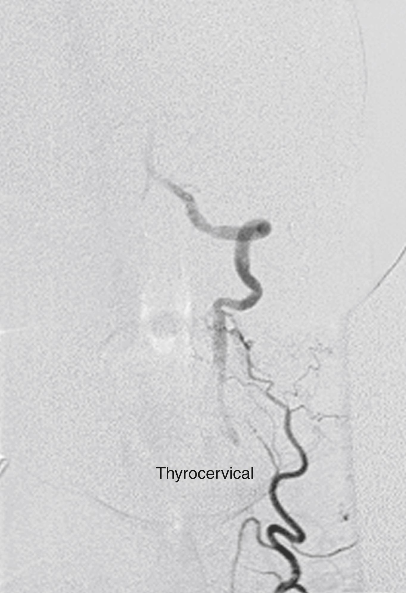 Figure 100.8, The distal vertebral and basilar arteries fed by a thyrocervical trunk collateral in a patient with proximal vertebral artery occlusion.