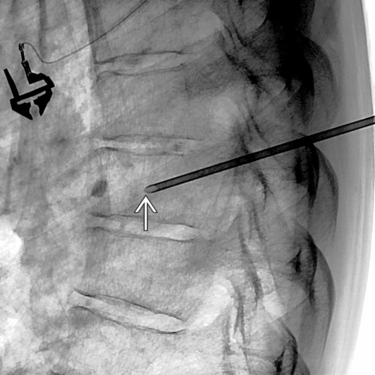 Transpedicular Approach