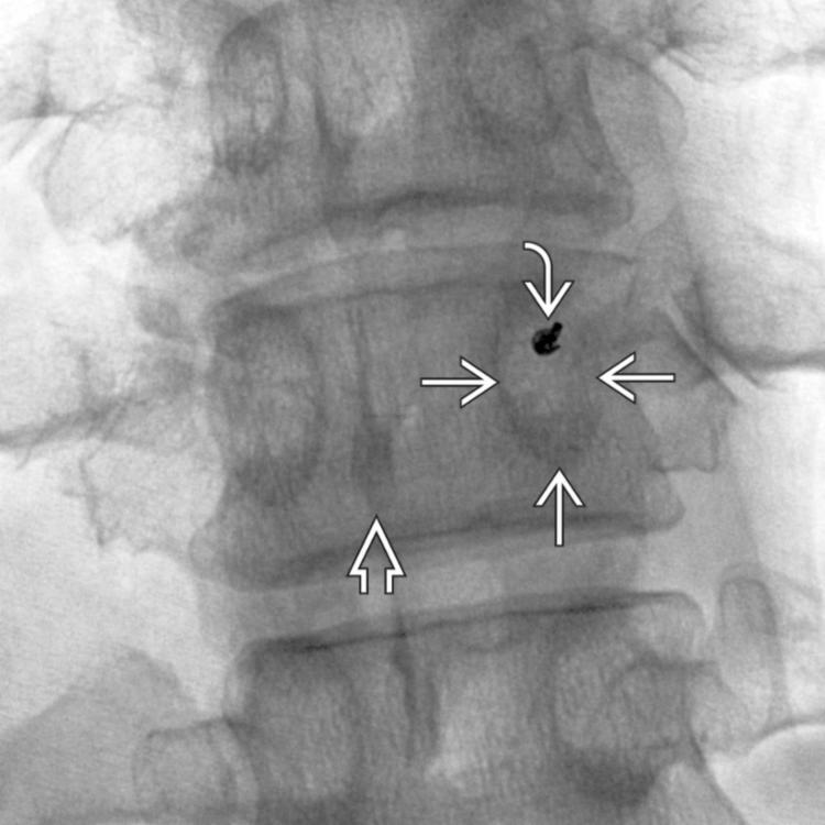 Pedicle Access