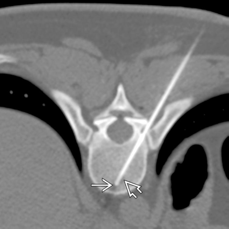 CT-Guided Biopsy