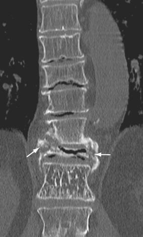 FIGURE 24-4, CT scan, coronal view, demonstrates avascular necrosis with collapse of the vertebral body and an associated intervertebral vacuum cleft ( arrows ).