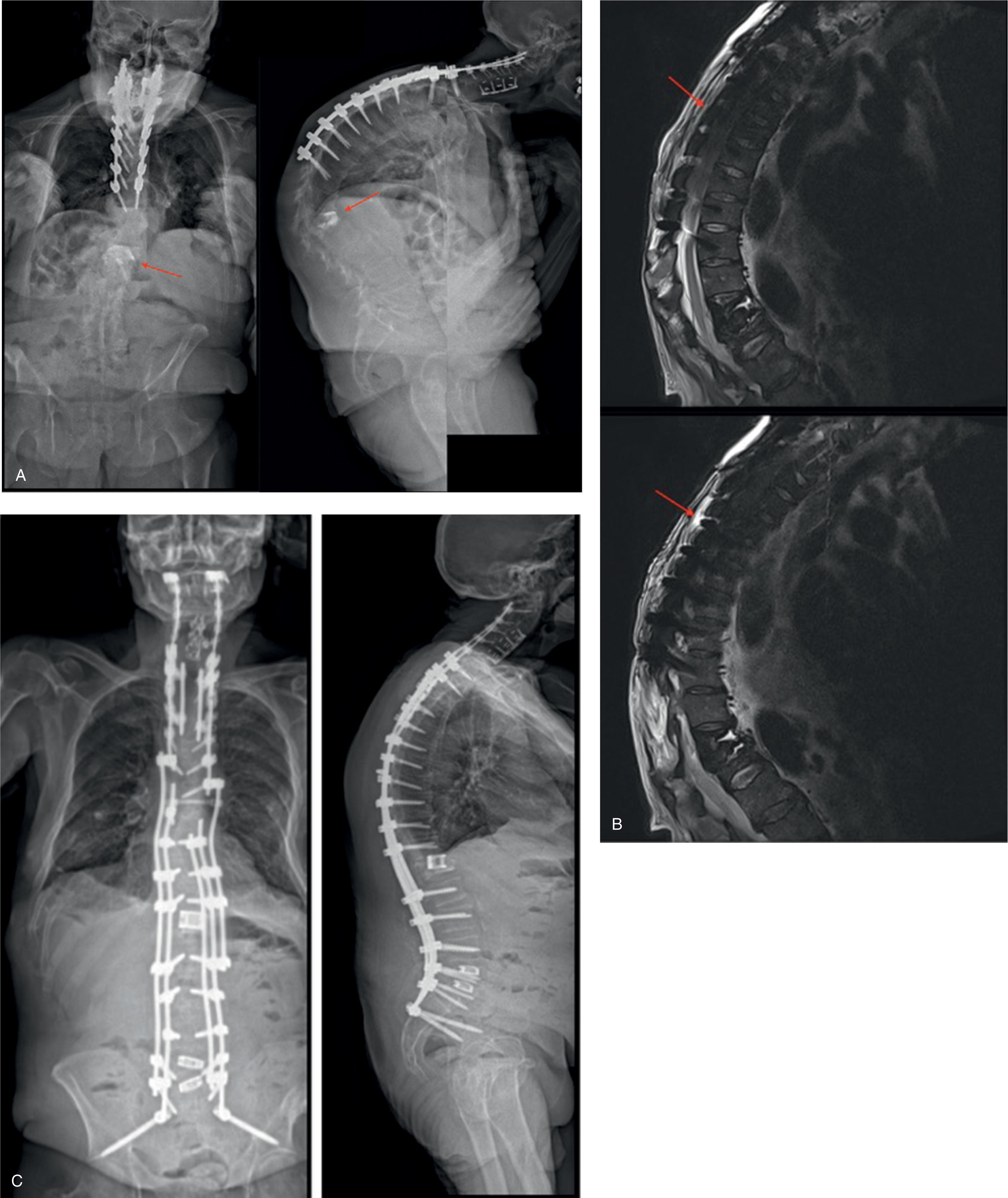 Fig. 19.1, (A) Standing anteroposterior (AP) and lateral radiographs of AF, a female patient with T12 and L1 vertebral collapse resulting in severe kyphosis (148 degrees) and sagittal imbalance. (B) Magnetic resonance image with gadolinium enhancement of the patient, AF, demonstrating some stenosis of the spinal cord but no gross neural impingement. (C) Following revision posterior spinal fusion with vertebral column resection of T12 and L1 and a transforaminal lumbar interbody fusion from L4 to sacrum, AF’s kyphosis was corrected to 58 degrees, with some improvement in coronal alignment as well. (D) Full-length AP and lateral standing films comparing preoperative and postoperative deformity of AF.