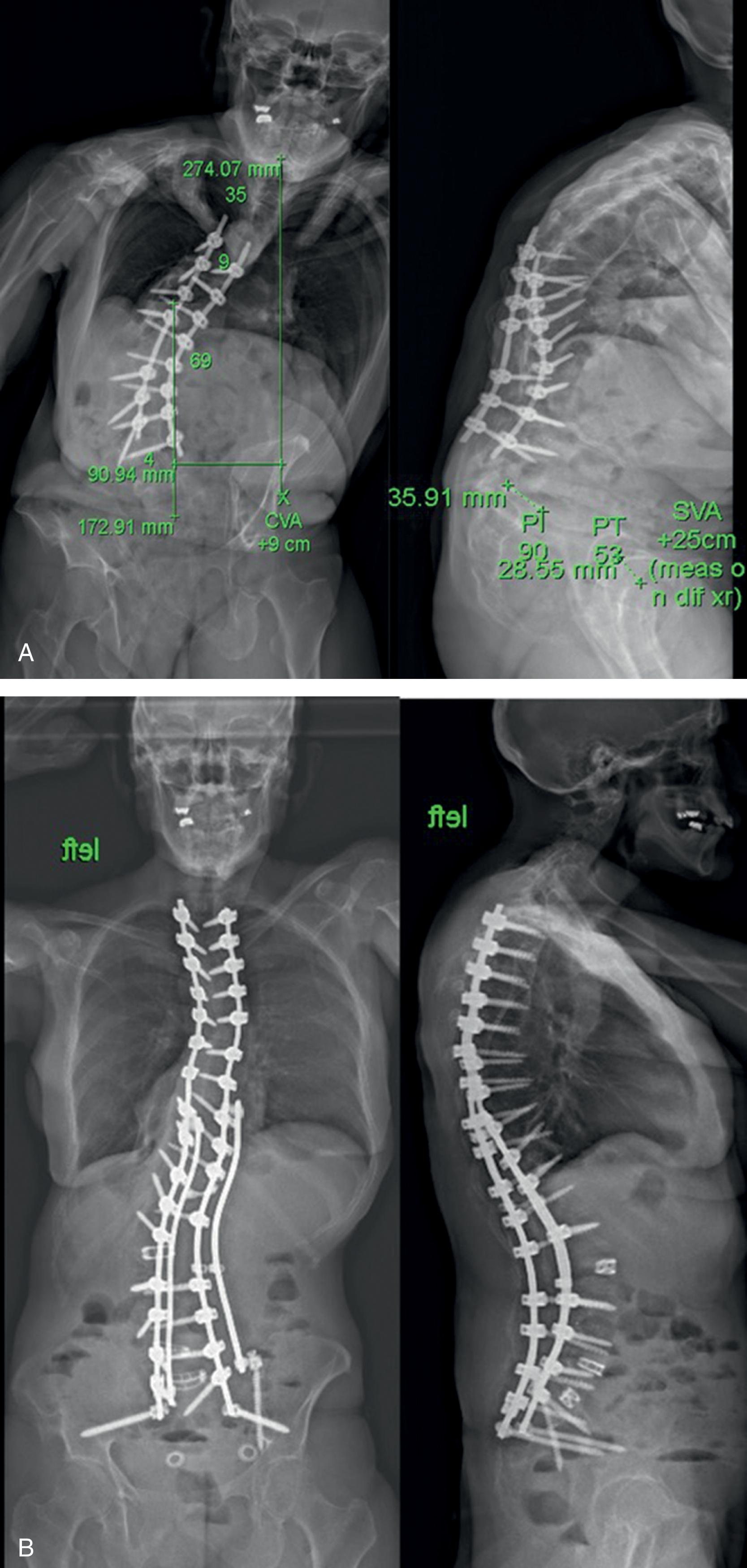 Fig. 19.2, (A) Standing anteroposterior (AP) and lateral radiographs of CS, a female patient with previous posterior spinal fusion from T9 to L4 who presented with significant coronal and sagittal imbalance. (B) Postoperative standing AP and lateral radiographs of CS following revision posterior spinal fusion spanning from T2 to the sacrum, with a vertebral column resection of L2, and transforaminal lumbar interbody fusion from L4 to S1. Resection of L2 at the apex of the patient’s deformity provided the maximum amount of correction of CS’s coronal and sagittal deformity resulting in restoration of truncal balance.