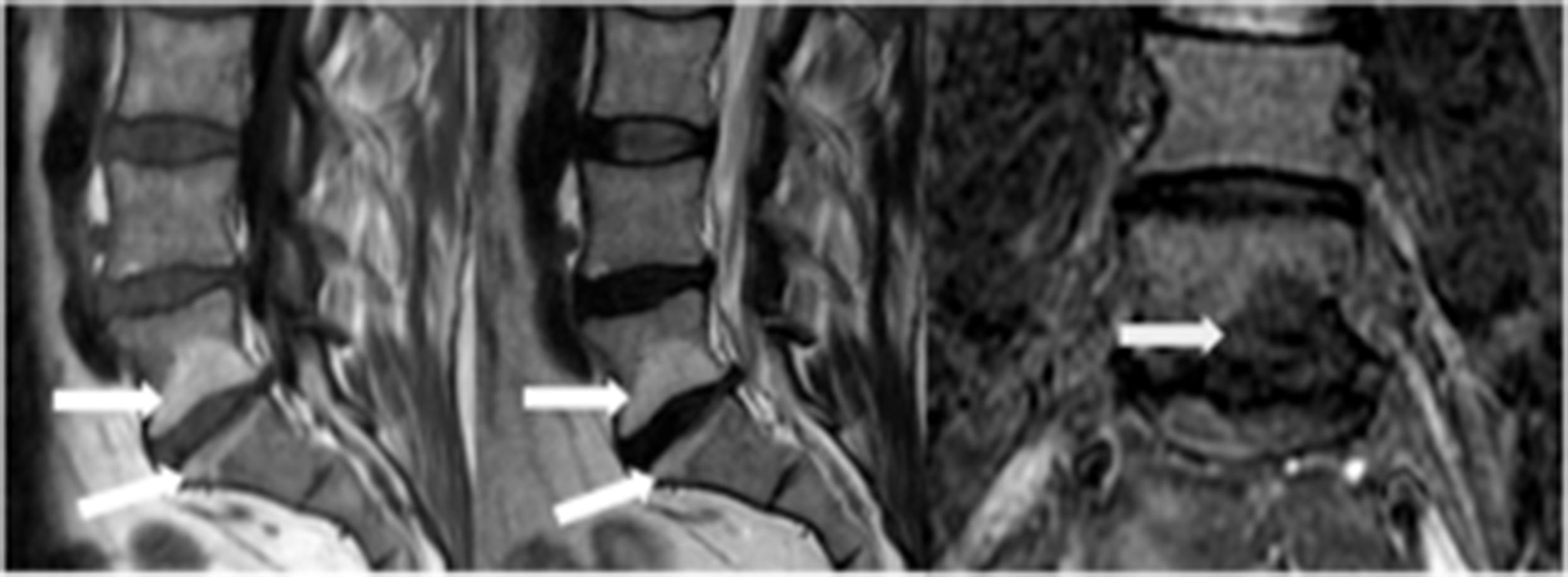 Figure 11.2, Sagittal T1- and T2-sequences and coronal STIR-sequence MRI showing Modic type 2 changes ( arrows ).