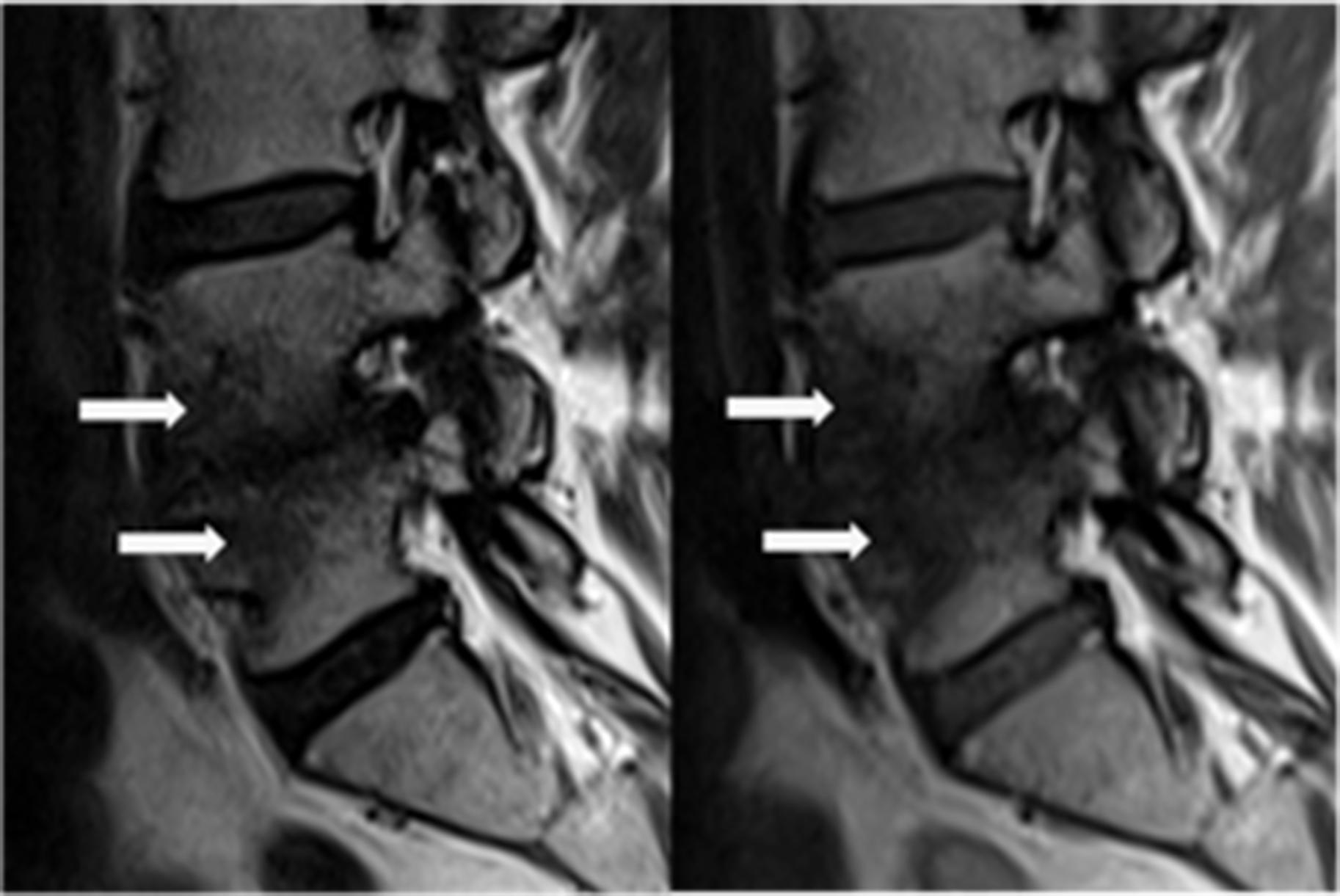 Figure 11.3, Sagittal T1- and T2-sequences MRI showing Modic type 3 changes ( arrows ).