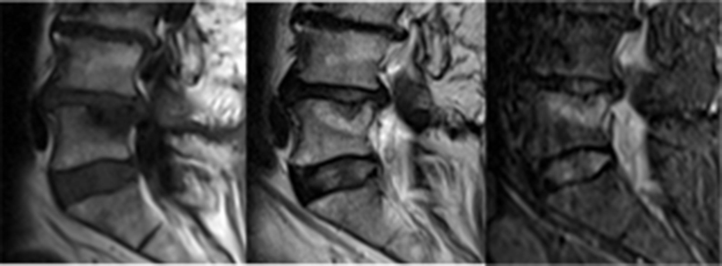 Figure 11.4, Sagittal T1-, T2- and STIR-sequences MRI showing Modic type 1 changes adjacent to Schmorl's node at the superior part of the L5 vertebra ( arrows ).