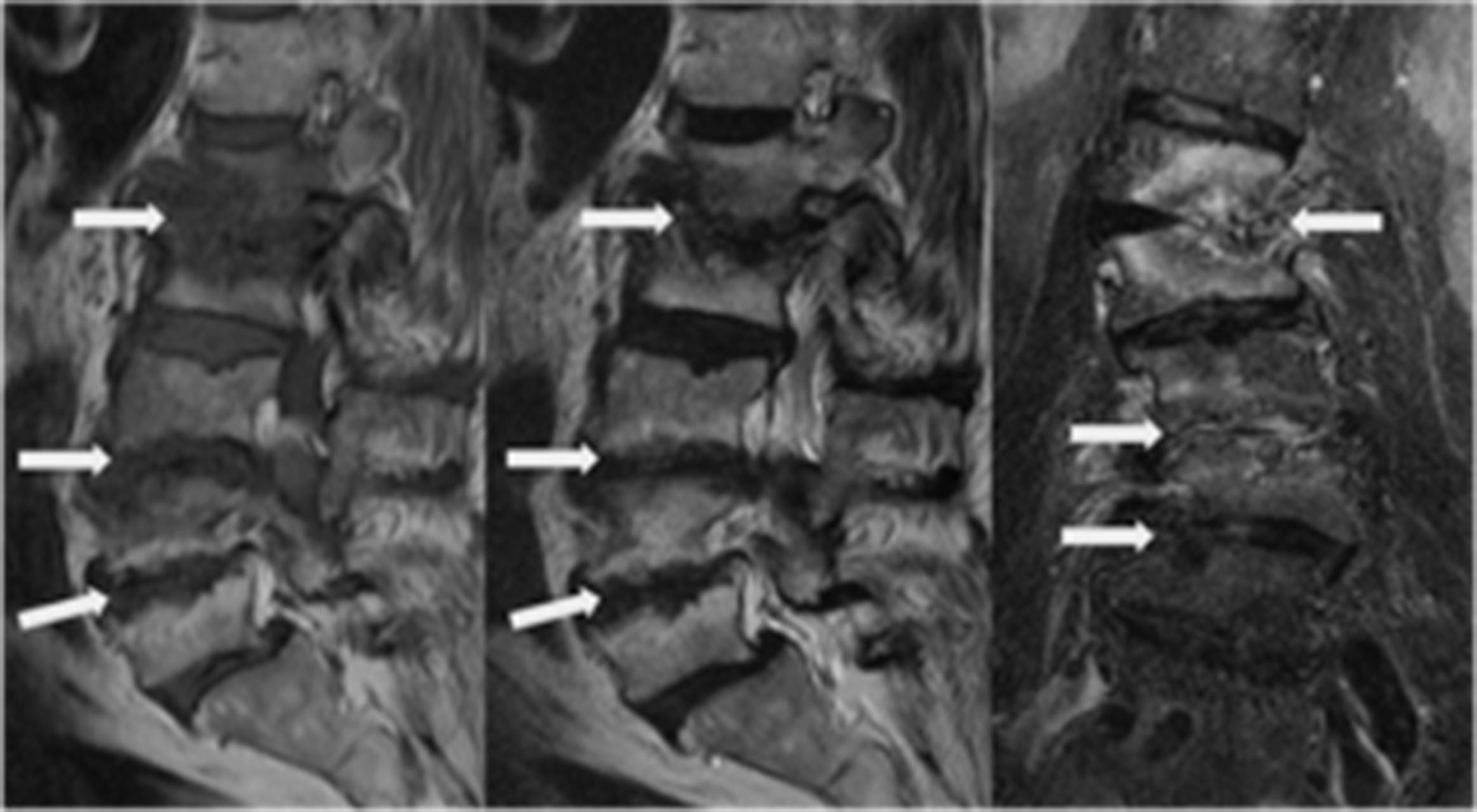 Figure 11.5, Sagittal T1- and T2-sequences MRI showing scoliosis and Modic type 1/2 at L1/2 and L3/4 and Modic type 2 changes at L4/5 ( arrows ) and coronal STIR-sequence showing Modic changes at the concave side of scoliosis ( arrows ).