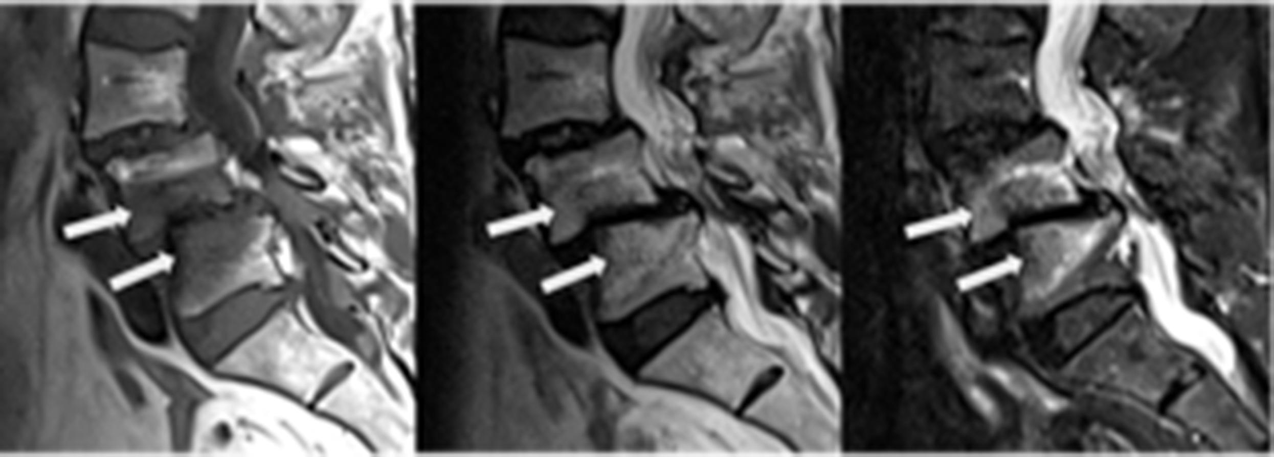 Figure 11.6, Sagittal T1-, T2- and STIR-sequences MRI showing instability and Modic type 1 changes at L4/5 ( arrows ); L3/4 is fused.