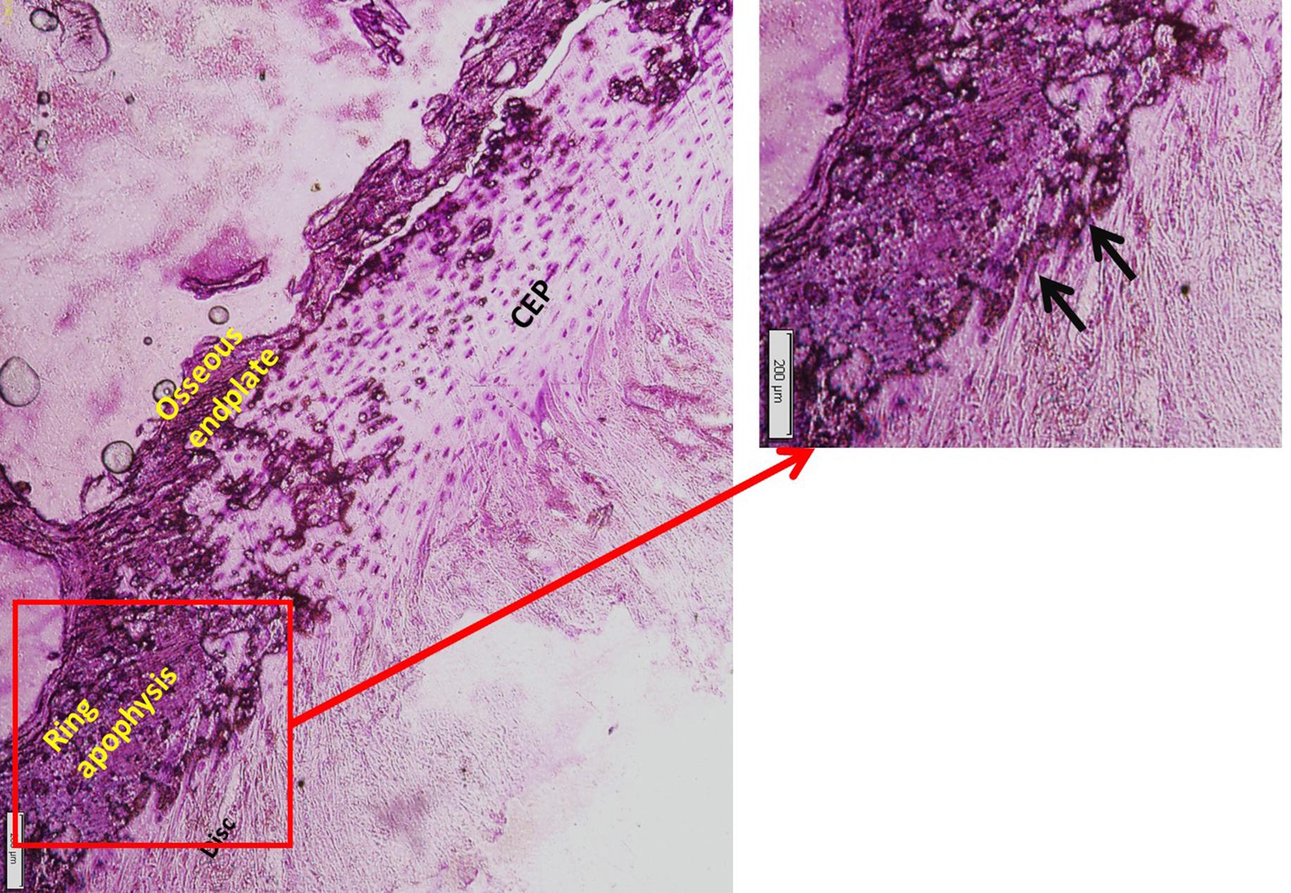 Figure 10.1, H&E section of an 81-year-old female showing the junction of the cartilaginous endplate (CEP) with osseous endplate. The periphery ring apophysis is also appreciated. Multiple calcified spots (black arrows ) are visible in the CEP. The inset shows a magnified view of the peripheral junction of the disk with a bony apophyseal rim annulus seen penetrating like Sharpey's fibers (black arrows ).