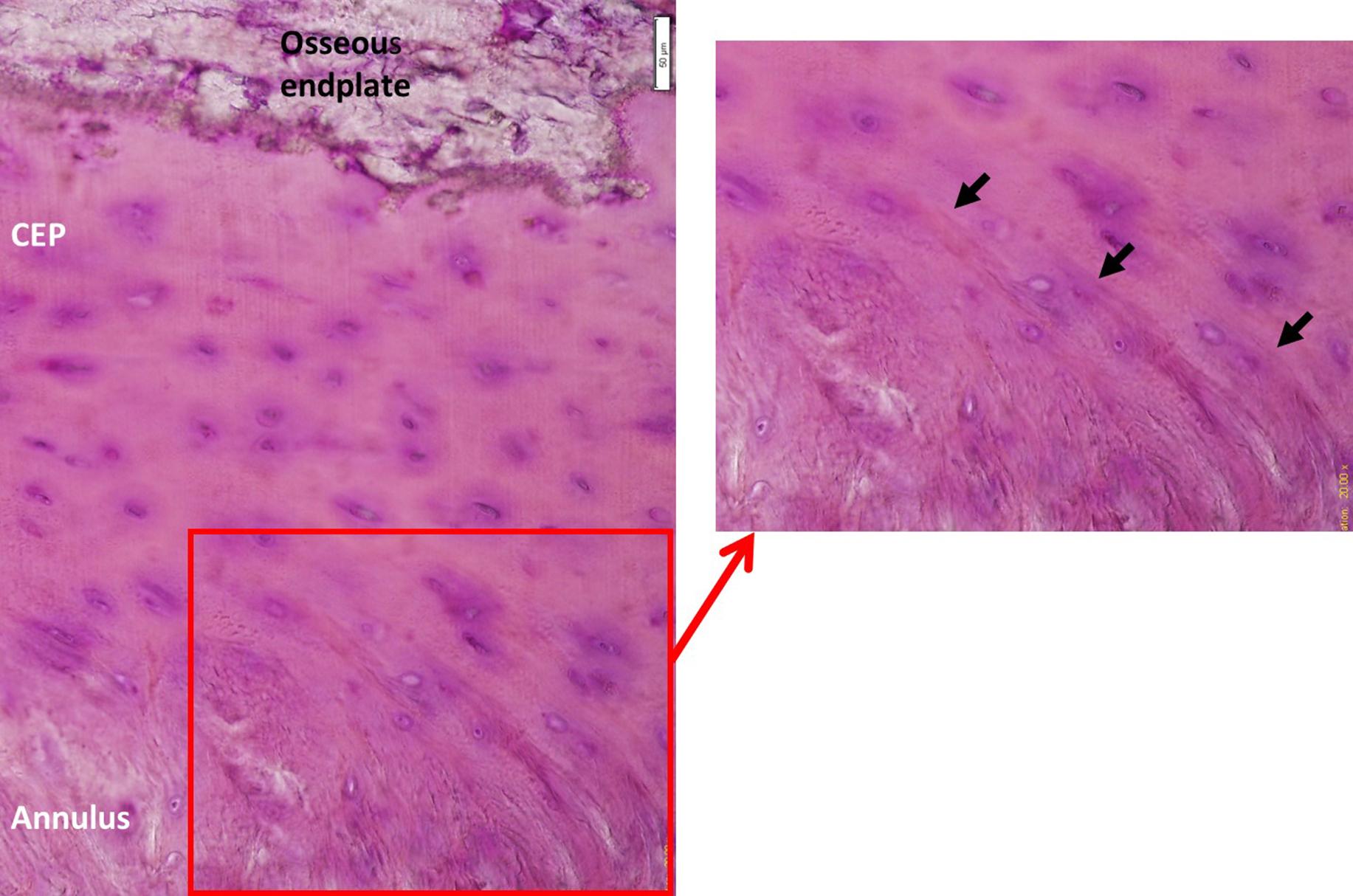 Figure 10.3, H&E section of a 75-year-old male showing the junction of the cartilaginous endplate (CEP) with the annulus. The CEP shows rounded chondrocytes distributed almost equally throughout the depth. The inset shows a magnified view of the inner annulus forming a continuity with collagen of the CEP (black arrows ).