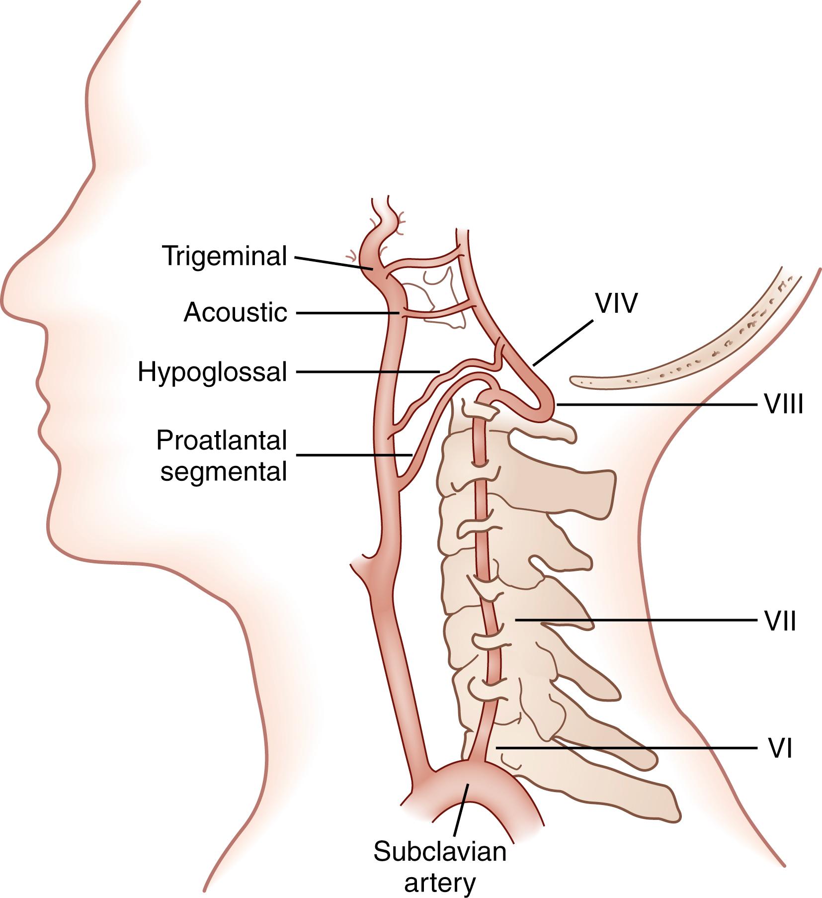 Fig. 26.1, Vertebral artery segments and persisting primitive anastomotic connections within the carotid arterial tree (VI–VIV denote vertebral artery segments 1–4).